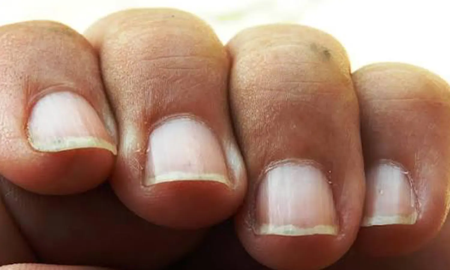Ciri-Ciri Kuku Tidak Sehat, Jangan Nail Art Dulu!